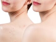 How to Get Rid of Shoulder Acne How-to-Get-Rid-of-Shoulder-Acne