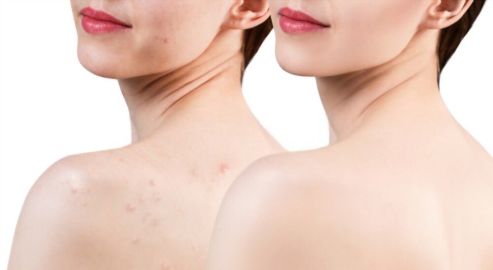 How to Get Rid of Shoulder Acne
